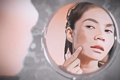 Melasma
