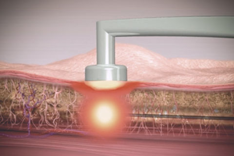 Radiofrequência Invasiva