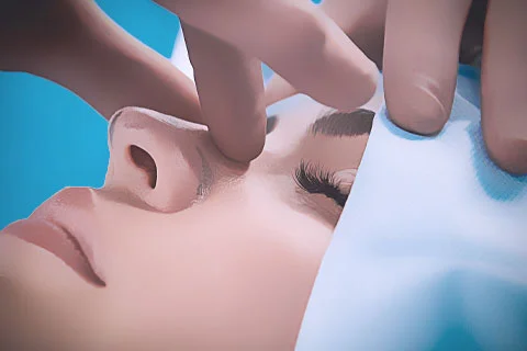 Rinoplastia