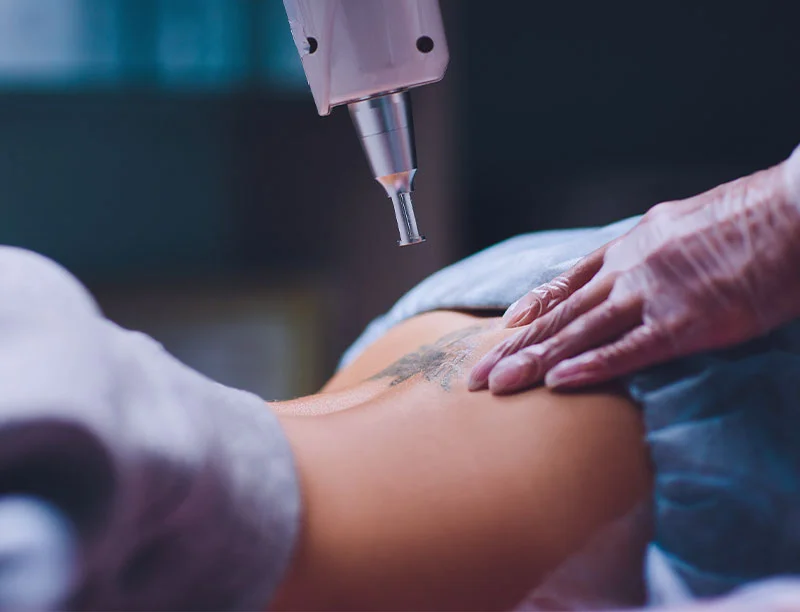 Qual a Função do Laser ND Yag no Rejuvenescimento?