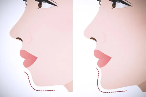 Mentoplastia