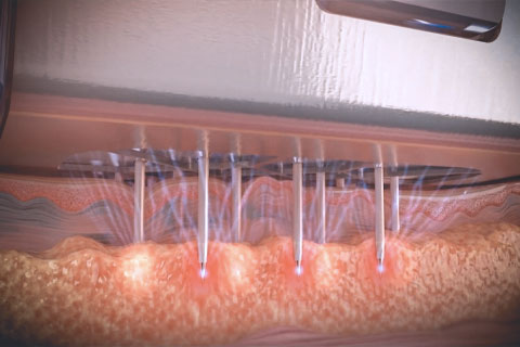 Microagulhamento Fracionado