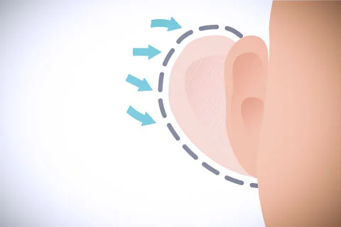 Otoplastia