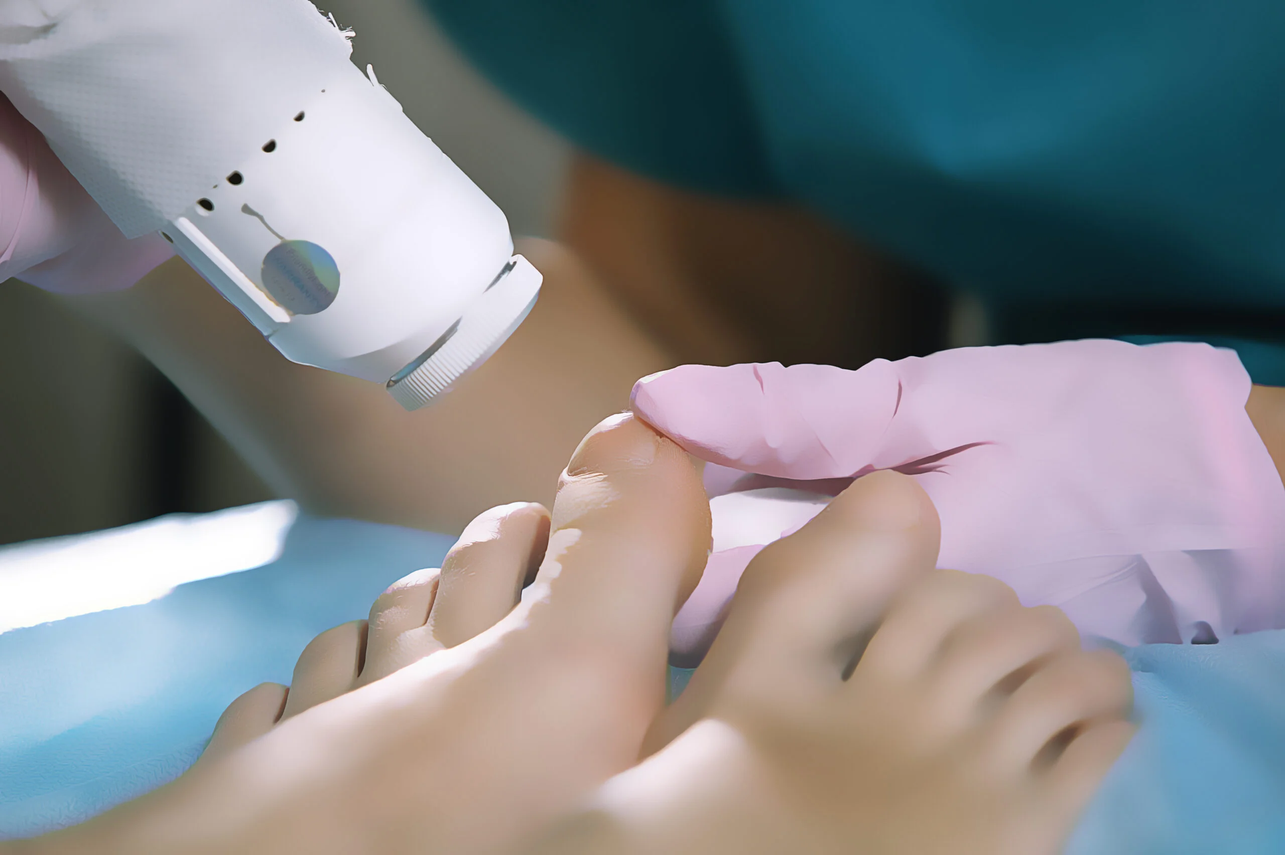 Tratamento A Laser Para Micoses nas Unhas